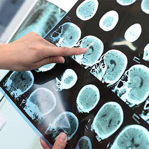 Alzheimer: novos métodos promissores para a detecção precoce da doença