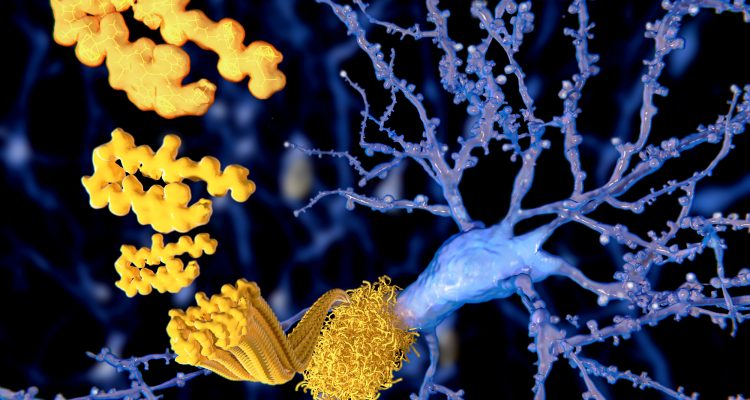 Estudos sugerem novas técnicas para tratamento do Alzheimer