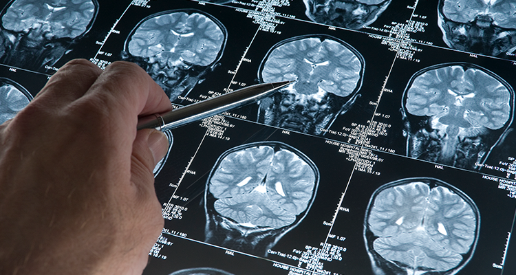 É possível diagnosticar o Alzheimer até 30 anos antes, diz estudo