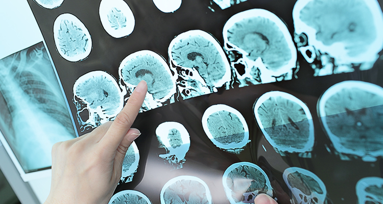 Esclerose múltipla pode desencadear reações psicológicas nos pacientes